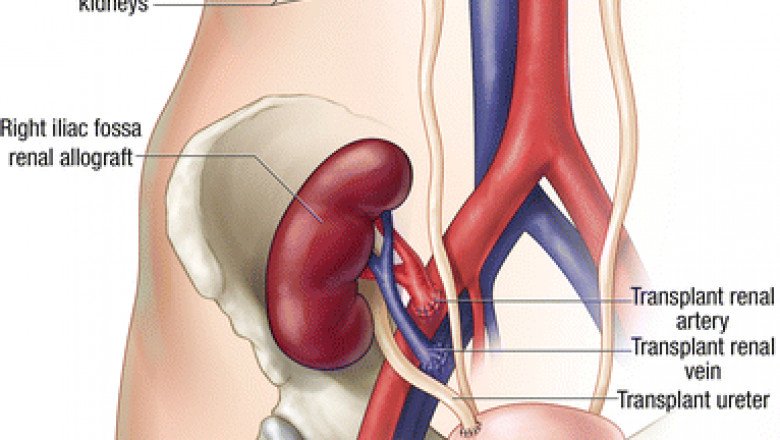 Kidney Transplant in Pune | Kidney Specialist in Pune