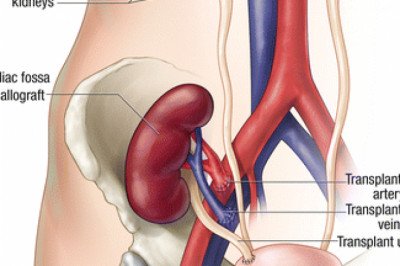 Kidney Transplant in Pune | Kidney Specialist in Pune