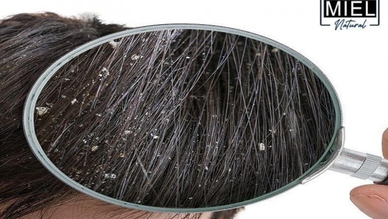 Miel Natural | Natural Remedies for Dandruff