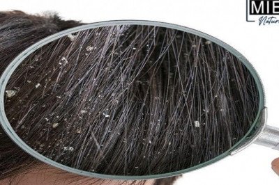 Miel Natural | Natural Remedies for Dandruff