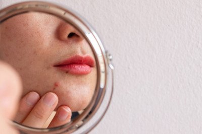 Prevention And Treatment Of Acne Excoriée