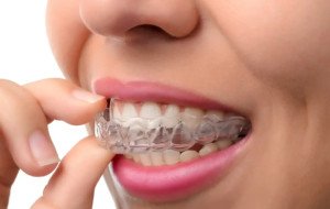 What Are the Best Clear Aligner Dentist Services in Lahore?