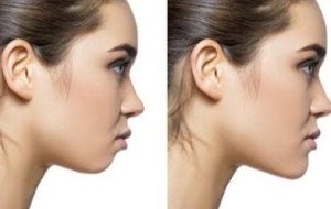 What Results Can You Expect From Double Chin Removal in Islamabad?