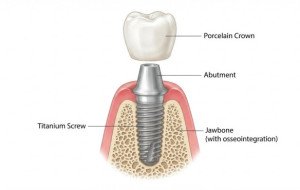 What Are the Stages of a Single Dental Implant Treatment?