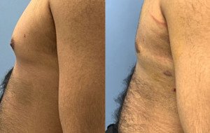 What Is the Recovery Process After Men Breast Tissue Removal?