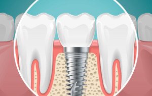 How Missing Teeth Can Affect Your Oral Health