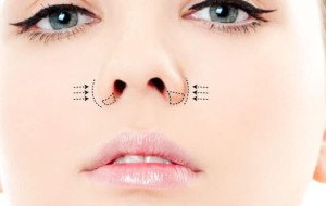Can Nostril Wings Change Without Surgery? What Patients With Wide Nostrils Should Know in 2026