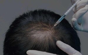 What Shapes Hair Coverage With DHI Direct Hair Implant in Dubai?