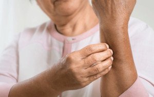 The Best Ways to Treat Bullous Pemphigoid with Natural Remedies