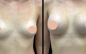 Best Doctors in Dubai for Understanding Breast Augmentation Recovery