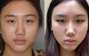Buccal Fat Removal Natural Results Best Doctors in Dubai
