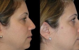 Double chin removal treatment Best Doctors in Dubai