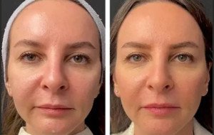 Best Plastic Surgeons in dubai for Mesotherapy: Under-Eye Treatment Benefits