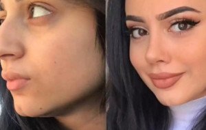 Septoplasty in Dubai: Important Facts Every Patient Should Know