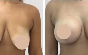 Breast Reduction Surgery in Dubai for Modern, Safe, and Personalized Treatment