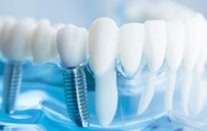 How to Choose the Right Option for Missing Teeth: Single Dental Implant or Mini Implants?